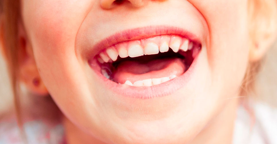 Caries in children: frequently asked questions