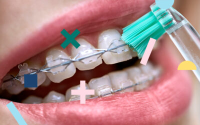 How to keep teeth free of stains with braces?