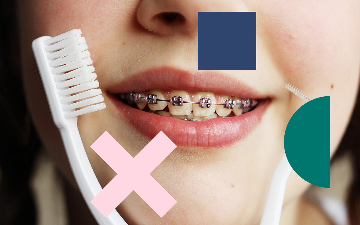 brushing with brackets