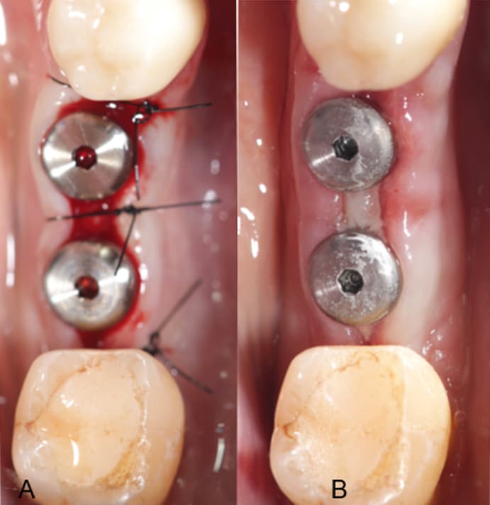 Cicatrização na colocação de implantes